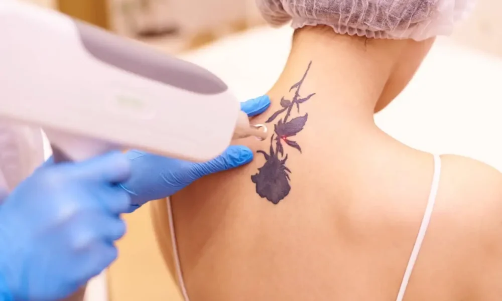 Tattoo Removal for a Clean Slate